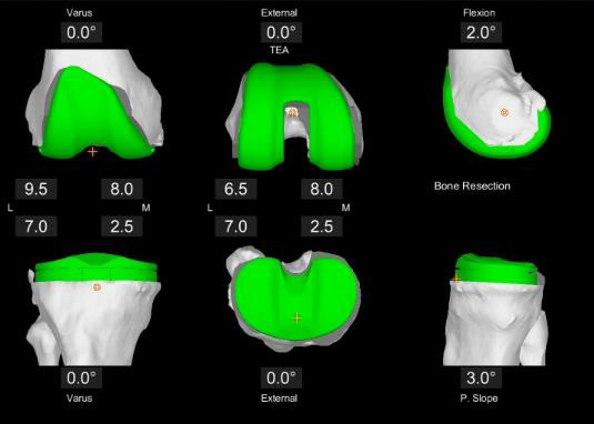 The Difference Between Conventional Surgery and Robotic Joint Replacement