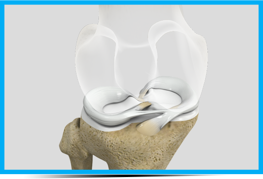 Meniscal Repair